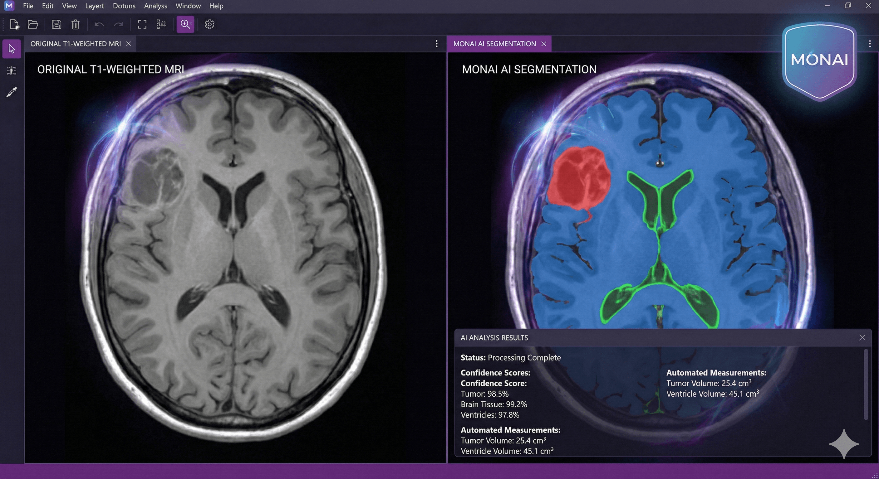 AI-powered image segmentation using MONAI technology