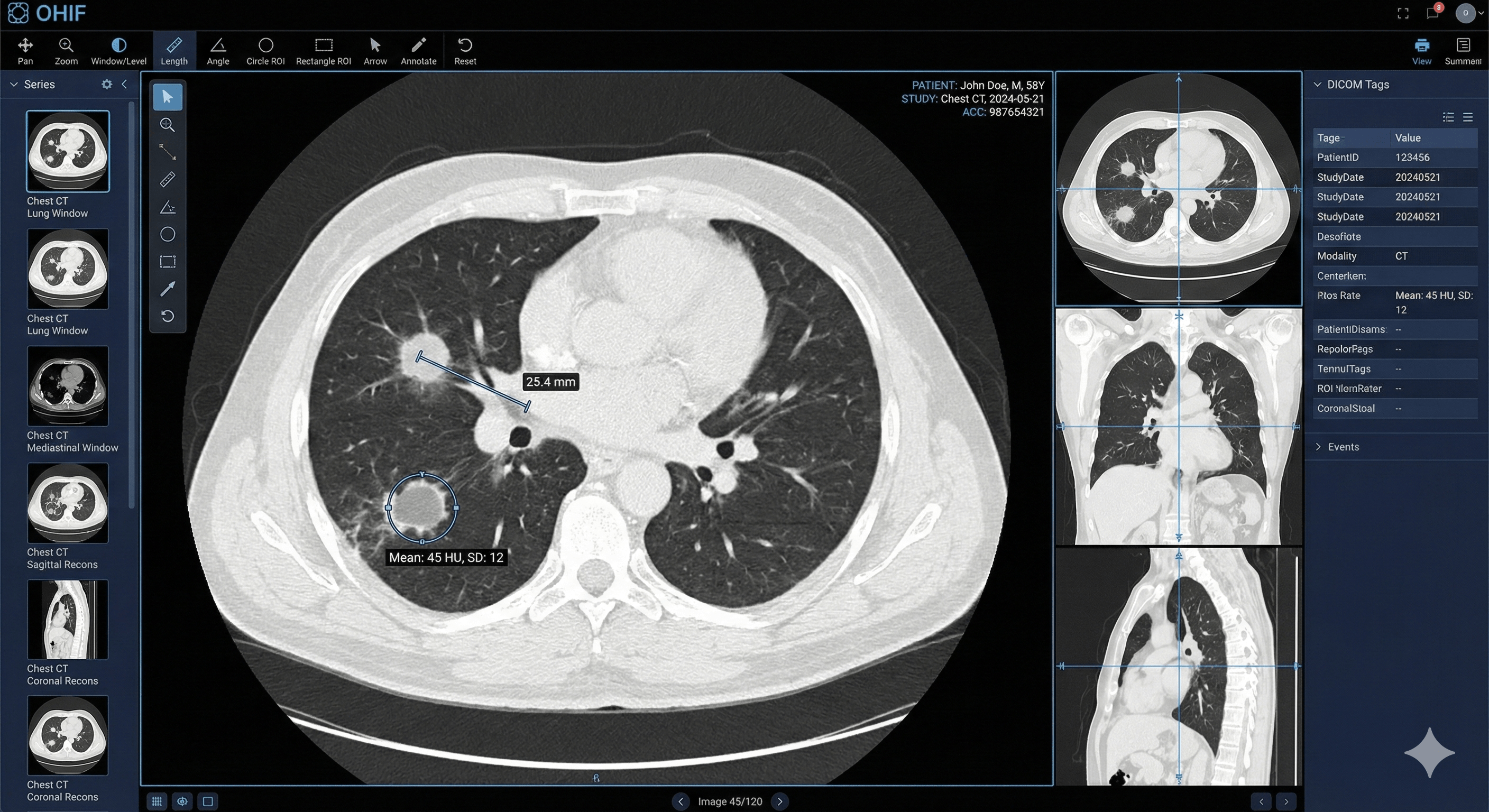 OHIF-based DICOM viewer with advanced visualization tools